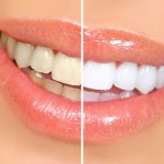sbiancante denti